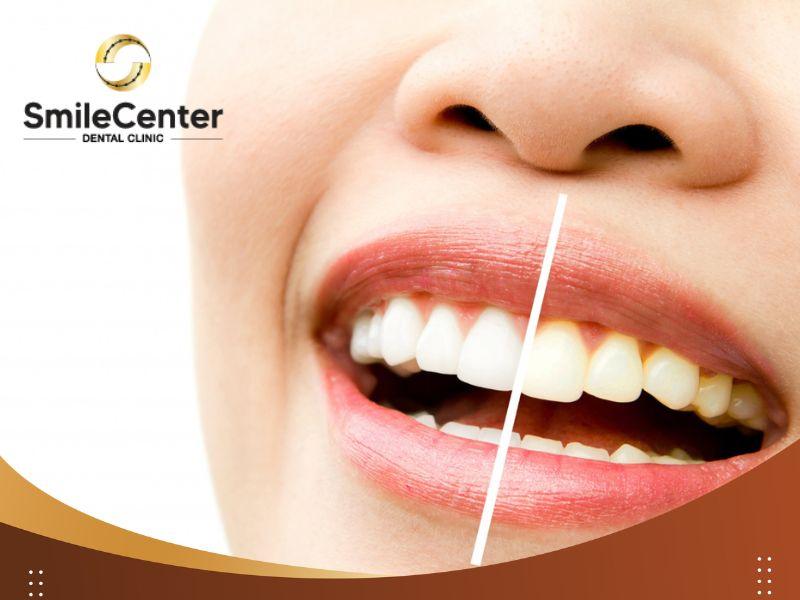 Cách ngăn ngừa ngà voi bị ố vàng